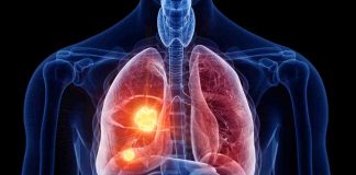 cancro al polmone screening