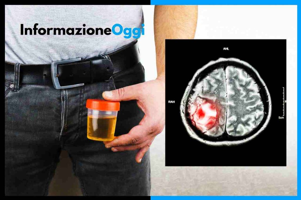 Tumore al Cervello con un Esame delle Urine