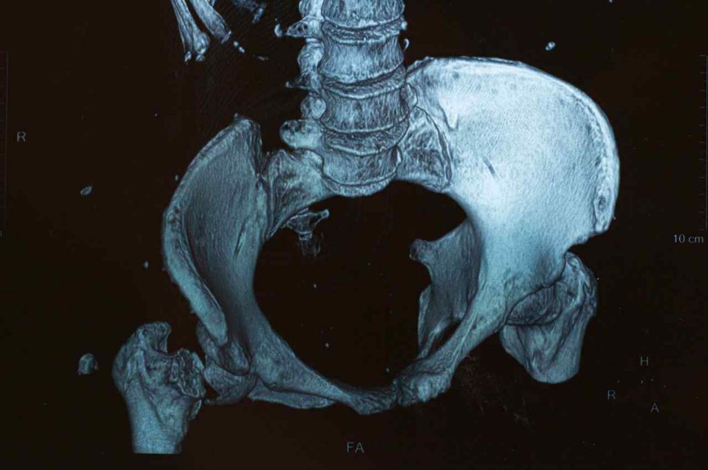 combattere l'osteoporosi per non incorrere in fratture