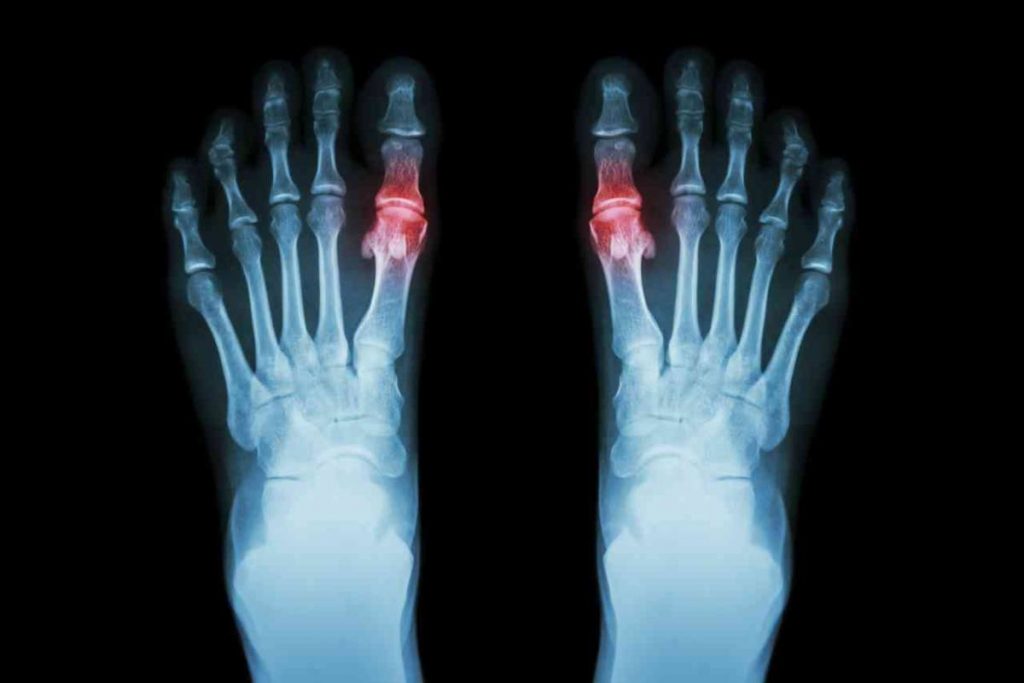 cos'è l'artrite reumatoide