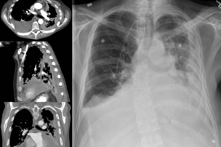 mesotelioma, lastra